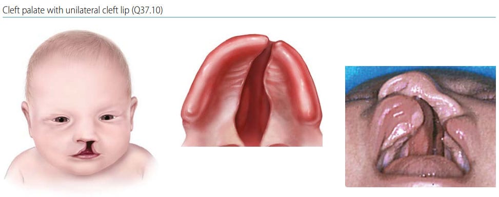 cleft palate anatomy