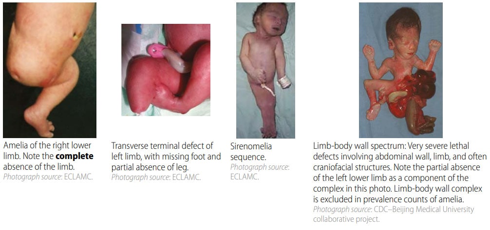 congenital limb deficiency