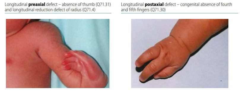 A CASE OF UNILATERAL TIBIAL HEMIMELIA WITH UNILATERAL RADIAL CLUB