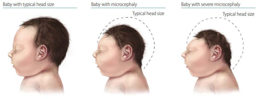 Congenital Anomalies of the Nervous System: Microcephaly | NCBDDD | CDC