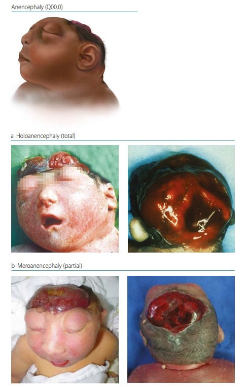 anencephaly survival rate