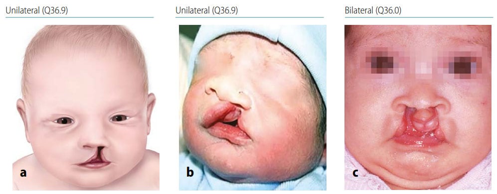 cleft lip and alveolus