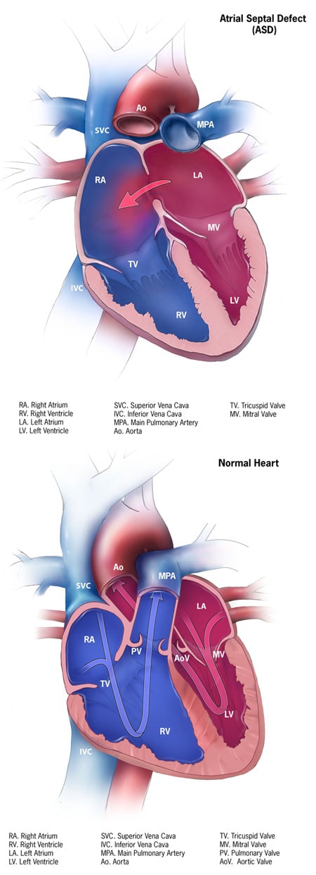 Congenital Heart Defects - Facts about Atrial Septal Defects