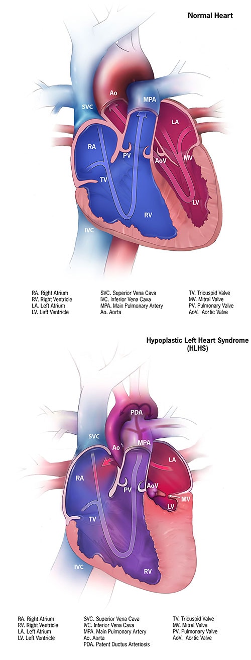 Congenital Heart Defects Facts About Hypoplastic Left - 