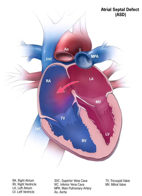 Congenital Heart Defects - Facts about Coarctation of the Aorta