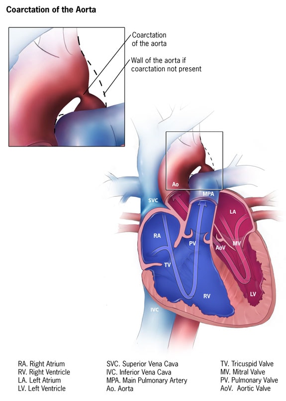 Congenital Heart Defects - Facts about Coarctation of the Aorta