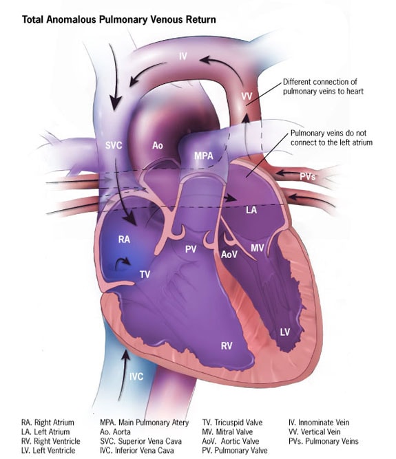 Congenital Heart Defects Facts About Tavpr Cdc