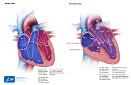 Tricuspid Atresia Heart Defects Ncbddd Cdc Mahoning County