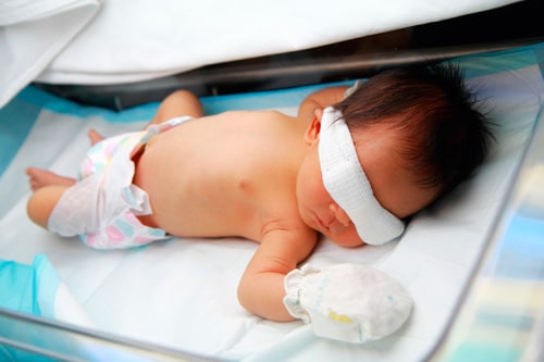 طفل حديث الولادة في حاضنة يرتدي واقيًا للعين للحماية من مصابيح العلاج الضوئي
