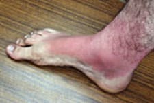 sunburned foot