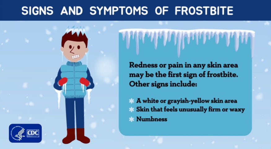 Signs and symptoms of frostbite