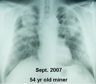 Pneumoconioses - Pictures