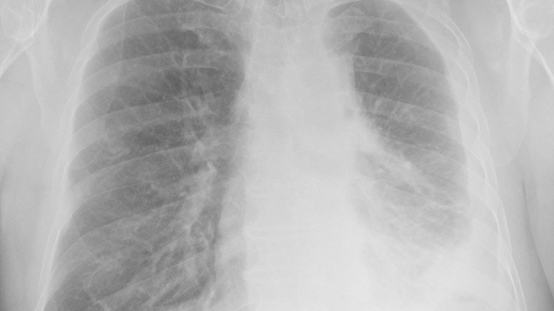 Chest x-ray of lungs with pneumoconiosis.