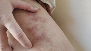 skin reaction showing rash hives allergy and inflammation. The skin has scars and dark spots on the leg of a women.