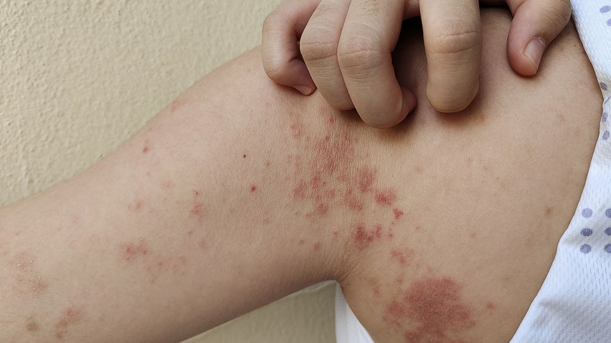 Chronic dermatitis, rash, hives and itchy skin from allergy on the back of a woman's arm