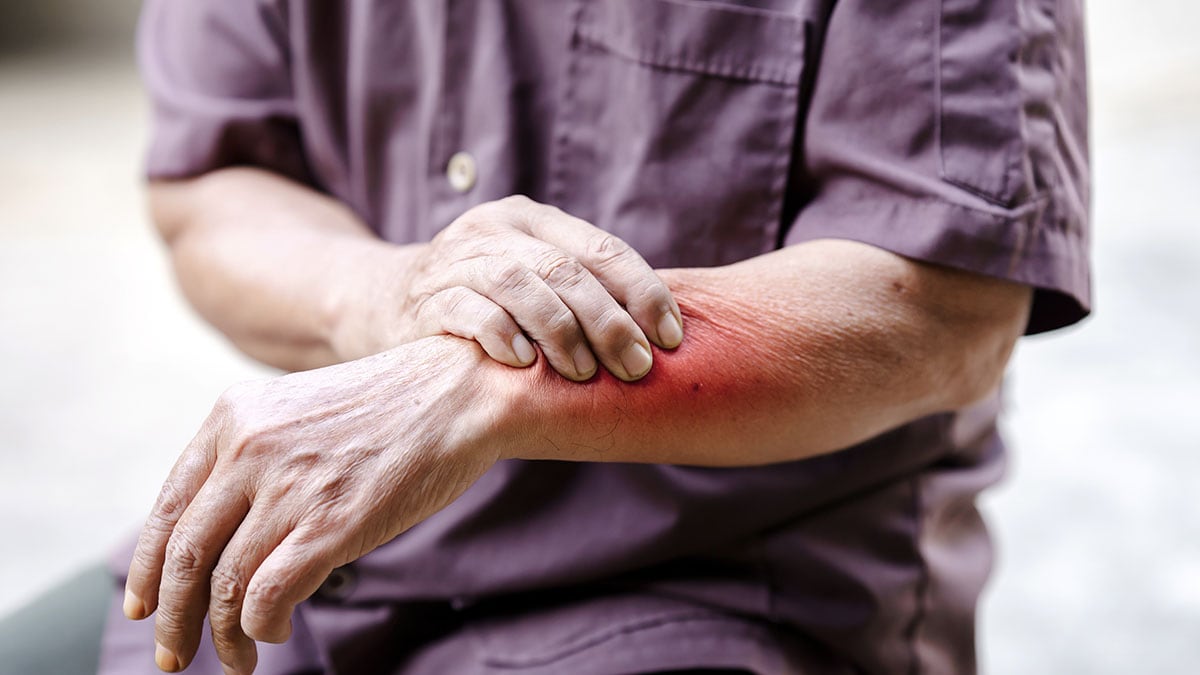 Image of a man holdng his arm that has a red skin rash