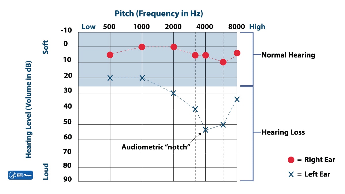 An audiogram showing a notch in the left ear where there is hearing loss.