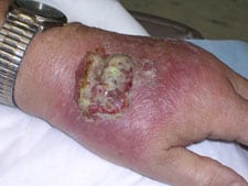 Image shows a person's hand with a large red and yellow scabby area taking up most of the back of the hand.