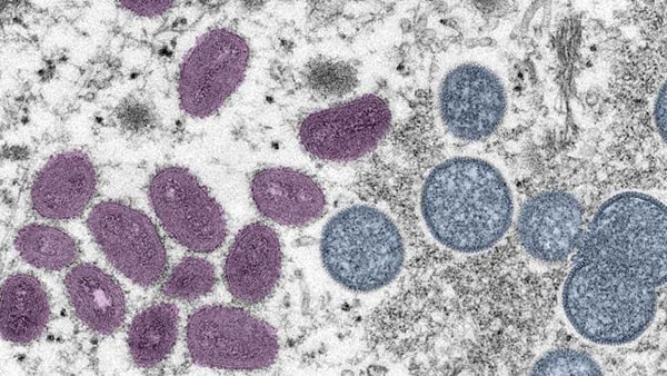 Microscopic image of Mpox virus