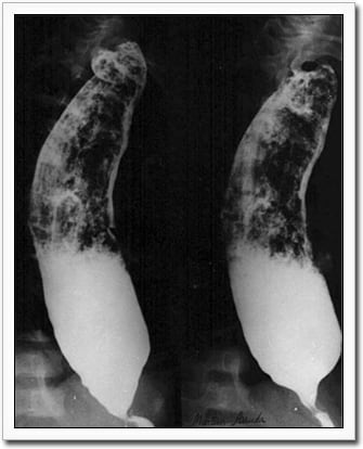 X-Ray image of megaesophagus in Chagas patient.