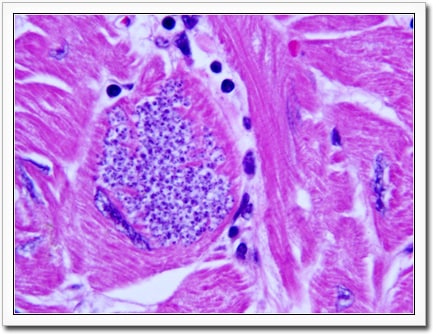 A biopsy of an explanted heart with signs of Chagas disease