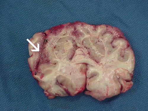 naegleria fowleri brain