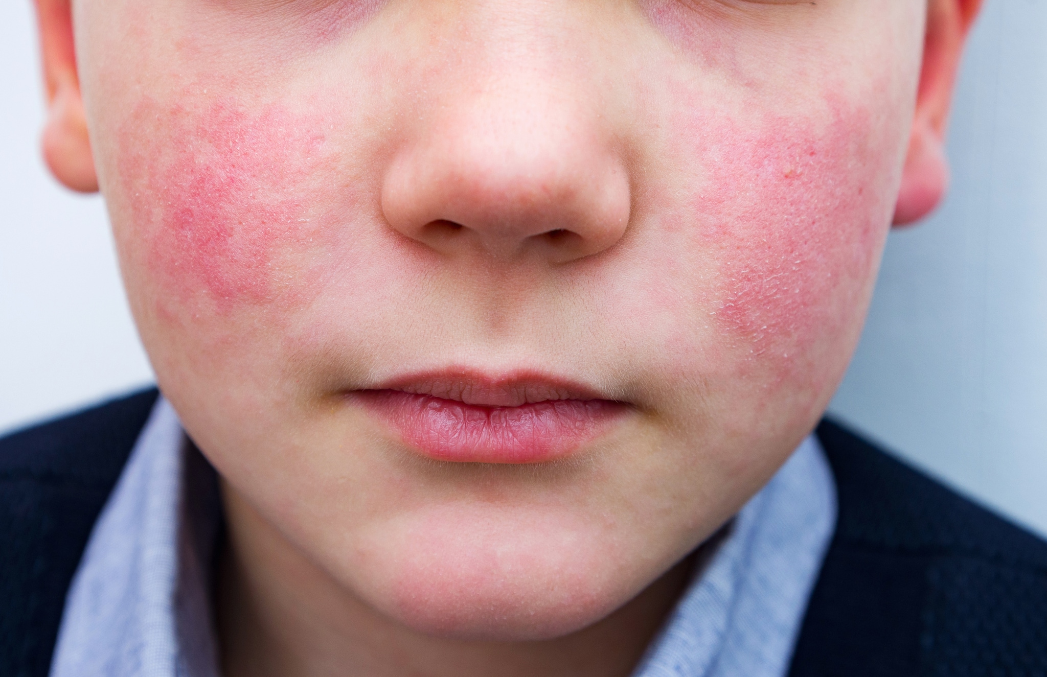 Image of parvovirus B19 "slapped cheek" rash