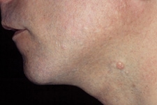 Typical molluscum lesion. Note the pearly appearance and the dimple in the center of the bumps. Image courtesy L. Sperling, MD, Walter Reed Army Medical Center.