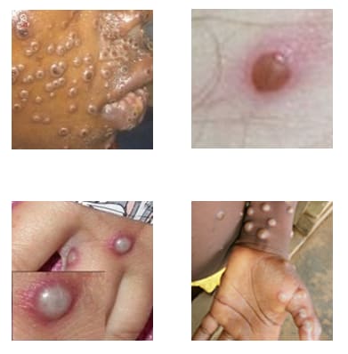 What is monkeypox and its signs and symptoms?