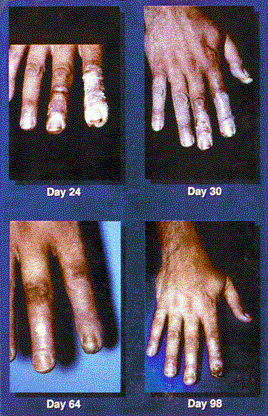 A human hand damaged by radiation in later stages.