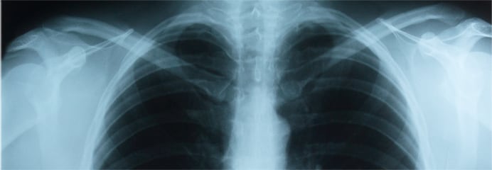 Example of an upper chest x-ray