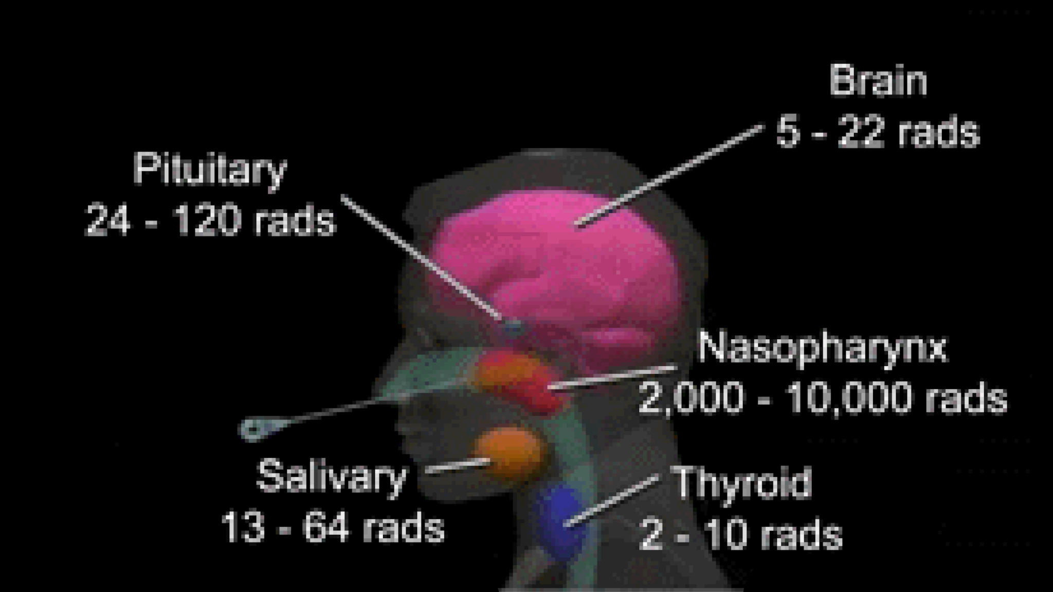 Example of radiation levels of human tissues during a Nasopharyngeal Radium Irradiation procedure