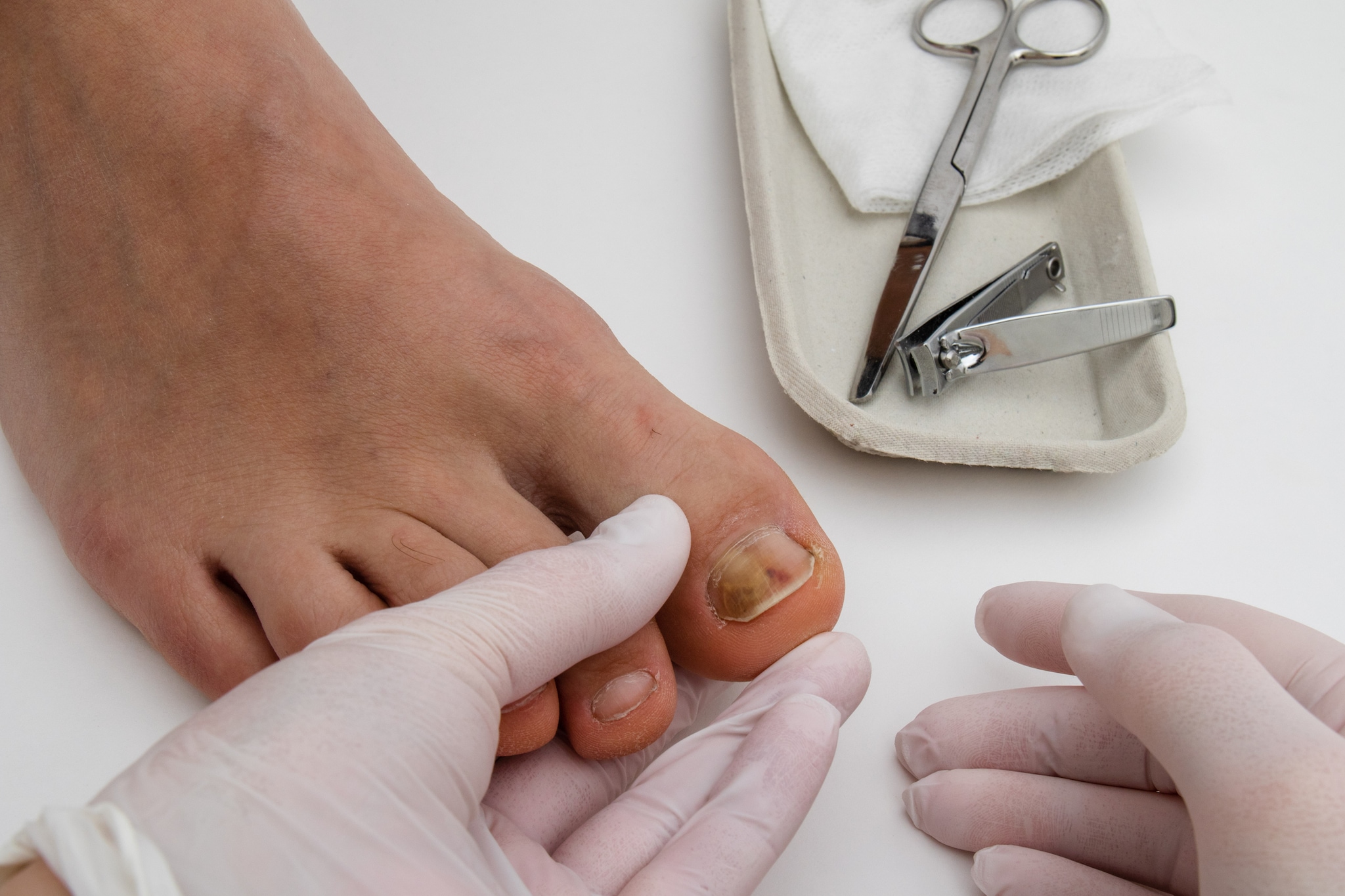 Stock image of two gloved hands treating a fungal nail infection on a toe nail.