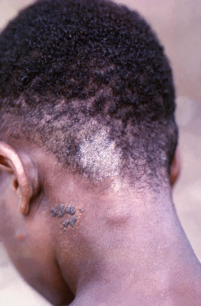 The back of the head of a boy of African descent with a round circular lesion at the hairline at nape of the neck.