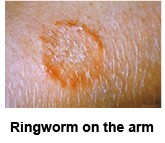 Ringworm on the arm.