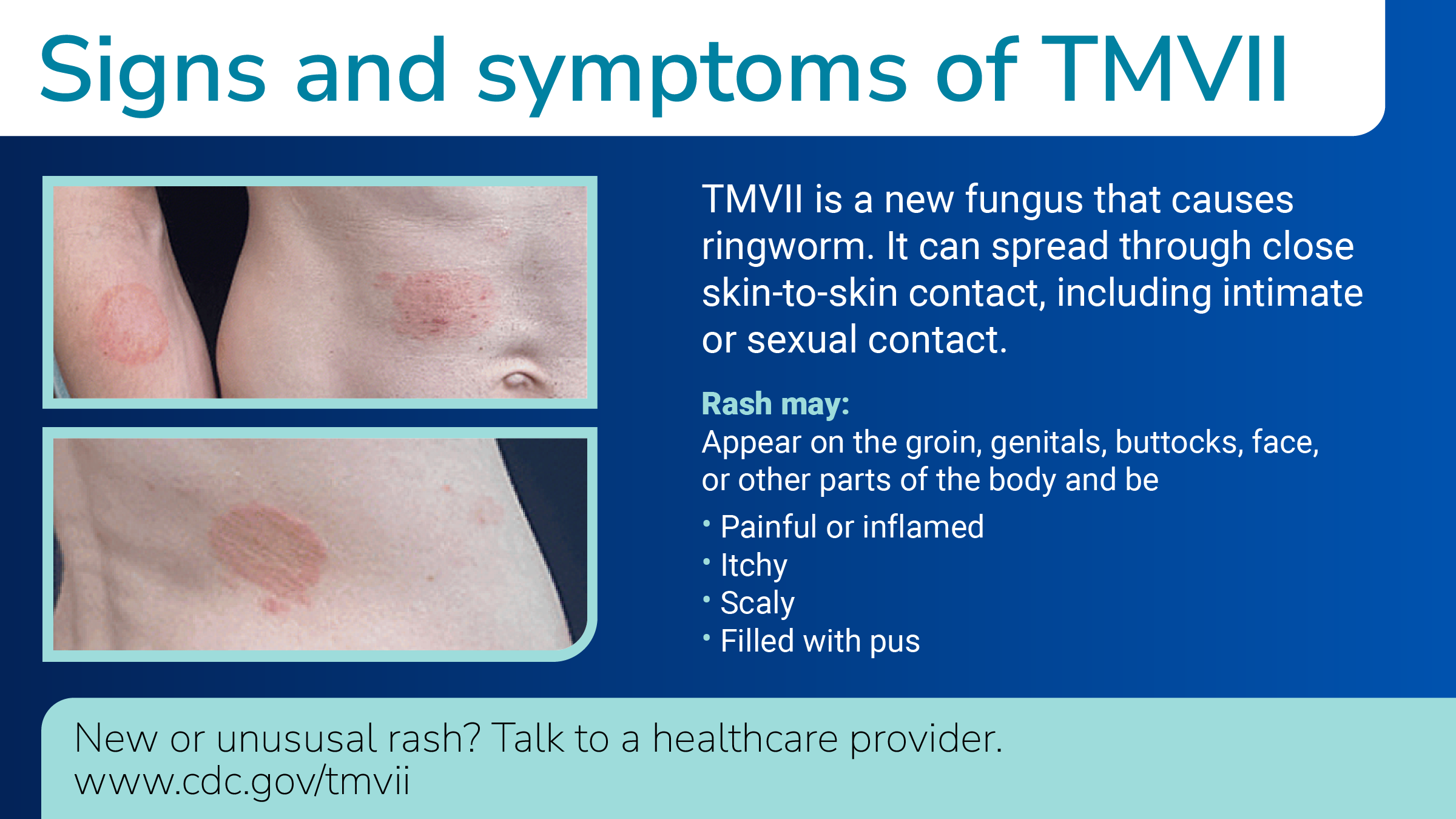Signs and symptoms of TMVII. TMVII is a new fungus that causes ringworm. It can spread through close skin-to-skin contact including intimate or sexual contact.