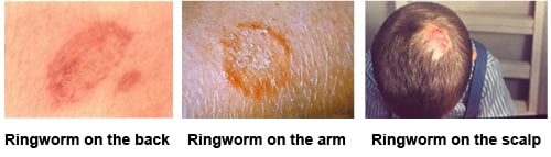 medical photographs of: ringworm on the back showing a red splotch on white skin, ringworm of the arm showing a red circle rash; and ringworm of the scalp showing a bald spot on the head.