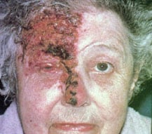 Elderly woman with shingles on her forehead, right eye,  and nose