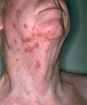 Person with light skin with shingles on neck. Source: PHIL Photo ID# 18254