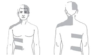 Visual of where shingles rash would commonly be on front and back of the body.