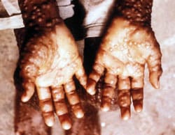 smallpox symptoms