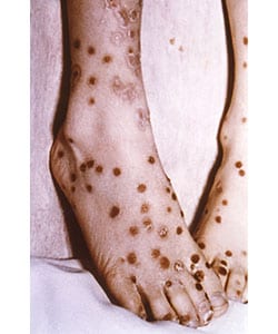 Feet of patient with modified-type smallpox. There is a %26ldquo;cropping%26rdquo; of the lesions in their distribution pattern. The rash resembles varicella. Source: CDC/Dr. Robinson.