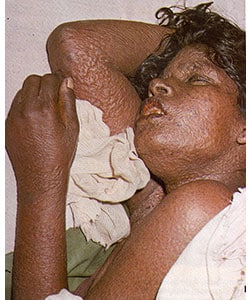 Woman with flat-type smallpox on 6th day of the rash. Image shows crepe-like lesions on her arms, hands, neck, and face. Source: Fenner F, Henderson DA, Arita I, Je%26#382;ek Z, Ladnyi ID. Smallpox and its eradication. Geneva, Switzerland: World Health Organization; 1988 (p.33)