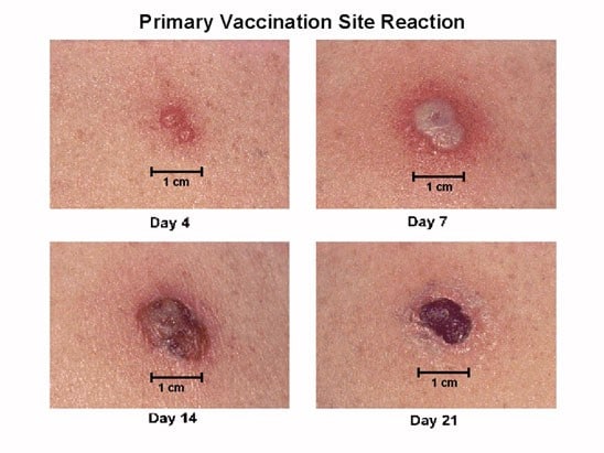 after effects of shingles vaccine injection