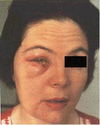 A woman's face with a swollen and red eye