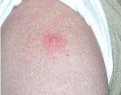 An upper arm with a rash and central lesion after smallpox vaccination