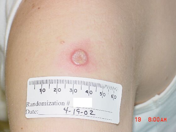 An upper arm with a grey lesion and red ring around it