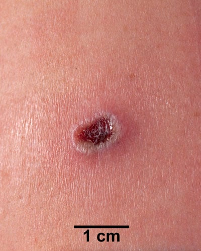 An arm with a dark red lesion