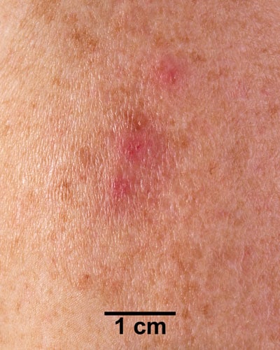 An arm with a small rash