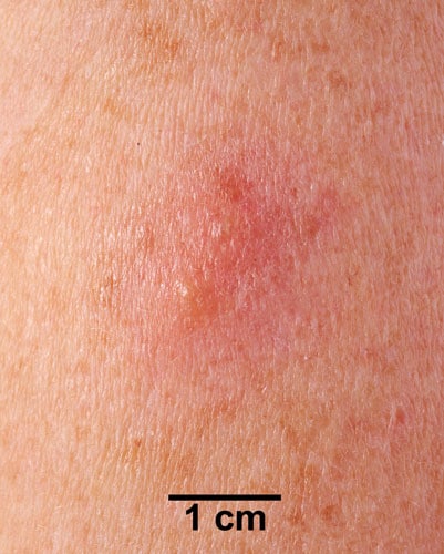 An arm with a small rash